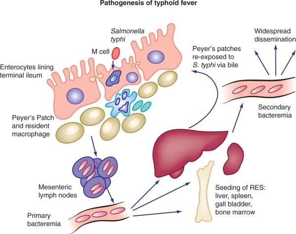 Diagnosis And Complications Of Typhoid