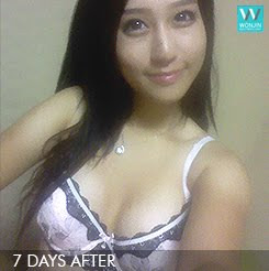 짱이뻐! - Looks Much Better After Korean Celebrities Breast Surgery