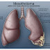 Mesothelioma – Your Basic Information