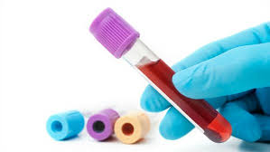 Exame de RT-PCR é considerado o mais confiável para detectar febre amarela