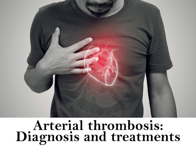 Diagnosis and treatments for Arterial thrombosis