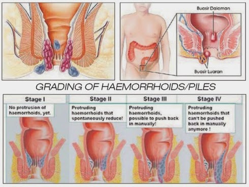 Ciri Terkena Ambeien atau wasir