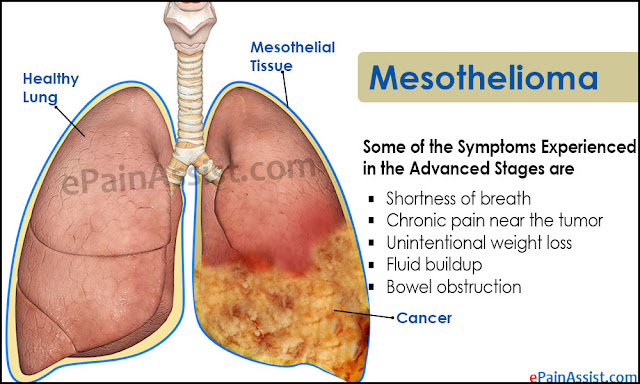 Mesothelioma