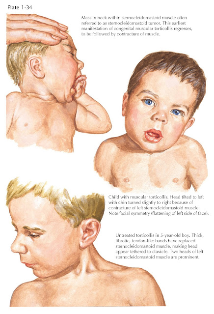 CLINICAL APPEARANCE OF CONGENITAL MUSCULAR TORTICOLLIS (WRYNECK)