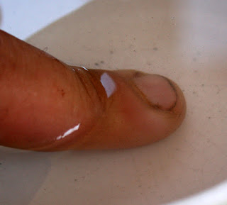 Infected finger in hot salt water