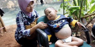 Obat Ginjal Bocor Untuk Anak