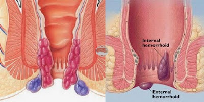 Berapa Harga Obat Wasir Di Lamongan