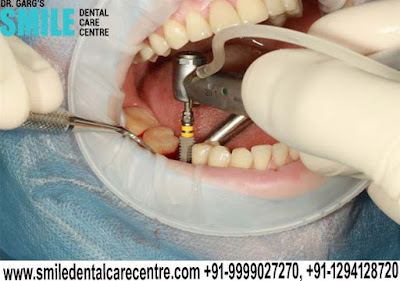 best dental implant in Faridabad