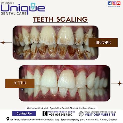 teeth scaling treatment in rajkot