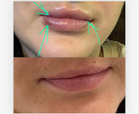1ml lip filler Before and After