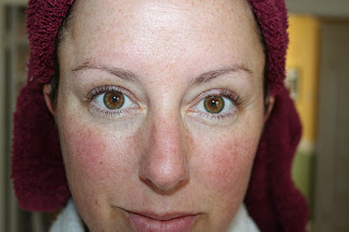 Rosacea Remedios Caseros