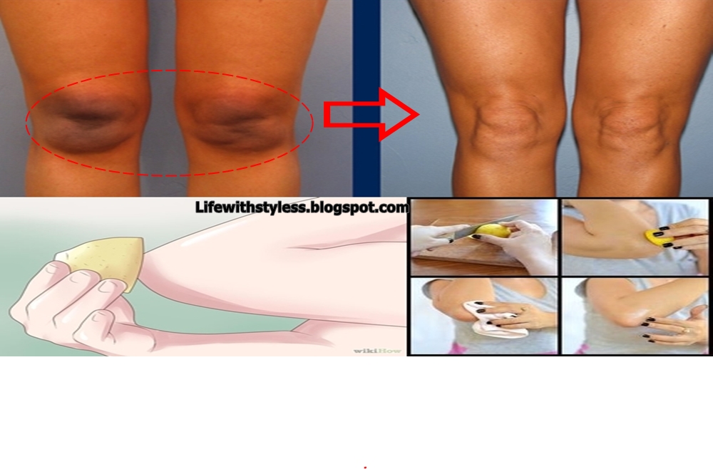How to Lighten Dark Knees and Elbows Naturally!!! | Life 