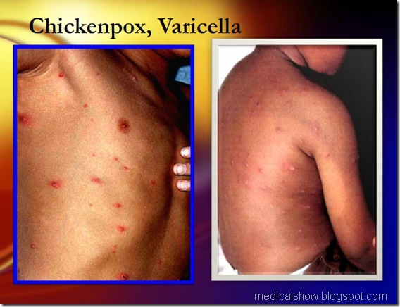 chicken pox, varicella