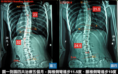 脊椎側彎, 脊椎度數,脊椎側彎矯正, 脊椎側彎矯正運動, 脊椎側彎治療, 脊椎側彎矯正成功案例, 脊椎側彎 推薦, 脊椎側彎 台中