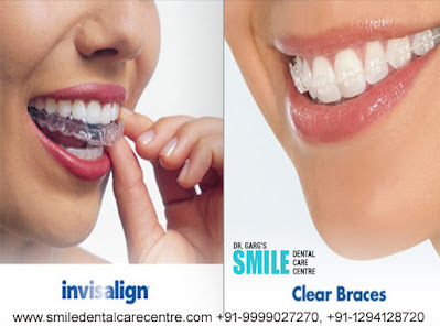 Best Invisible Aligner Treatment