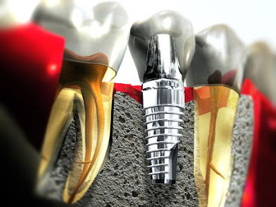 Trồng răng Implant cho người cao tuổi