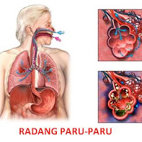 Obat Penyakit Paru Paru.Com