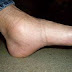 Pés inchados e tornozelos inchados - Home remédios para o inchaço do tornozelo.