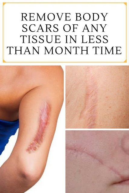 REMOVE BODY SCARS OF ANY TISSUE IN LESS THAN MONTH TIME