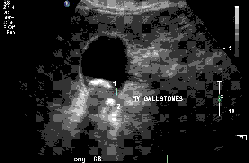 gallbladder stones ultrasound. .is to pass a gallstone,