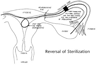 tubal reversal images illustration pictures