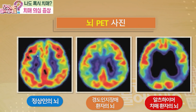경도인지장애와-치매-환자의-뇌-사진