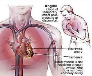 coronary heart disease