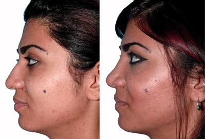Nose Job Before After
