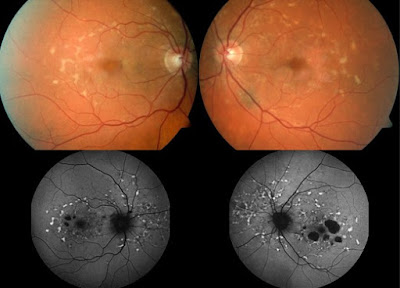 Stargardt Disease Pictures