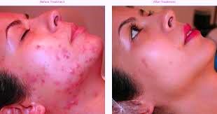 acne treatment in chennai