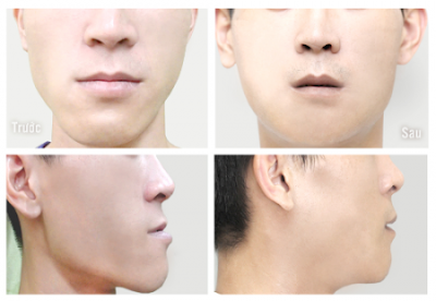 Phương pháp niềng răng hô giá bao nhiêu tiền ?