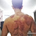 Why you should try cupping therapy