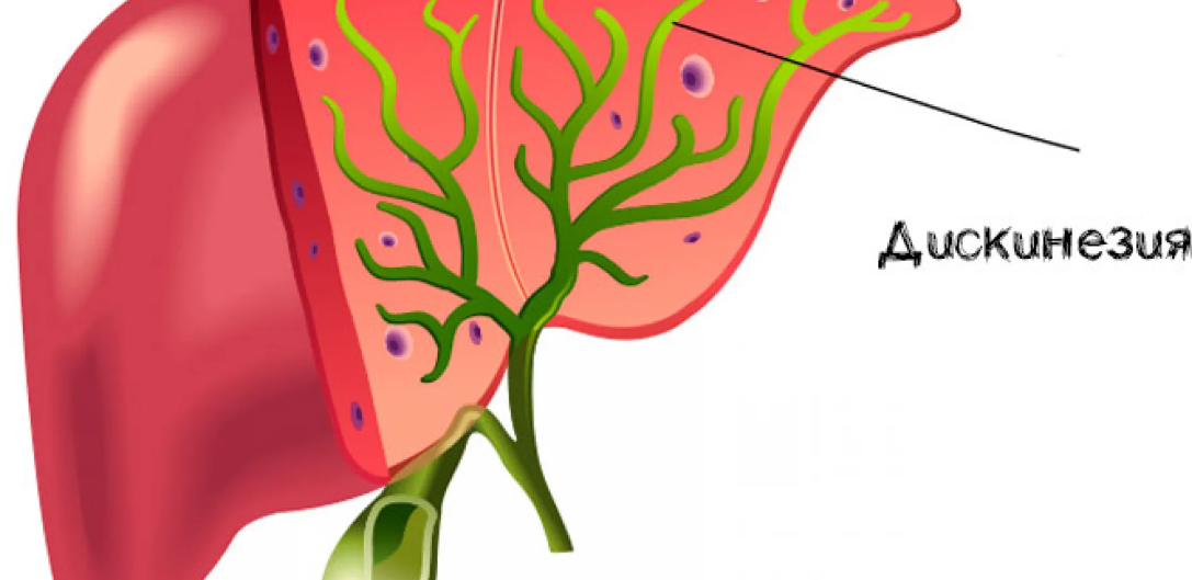 Болезнь желчных протоков. Дискинезия жёлчного пузыря и желчевыводящих путей. Дискинезия желчевыводящих путей (джвп). Дискинезия желчного пузыря и желчных путей..