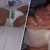 Bayi 6 bulan melecur teruk di muka selepas gigit kabel pengecas handphone