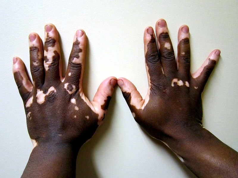 White discoloration on skin - Pale skin discoloration 