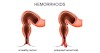 It May Be Helpful to See a Hemorrhoid Specialist