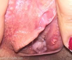 HPV Menular