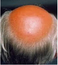 Androgenetic alopecia