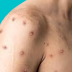 How environmental change can cause infections like monkey pox