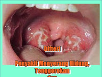 Difteri dan Difter Tetanus Penyakit Yang Menyerang Hidung dan Tenggorokan