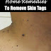 9 Natural Home Remedies to Remove Skin Tags