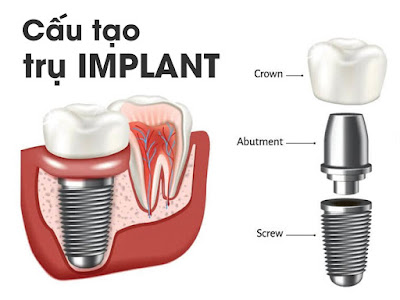 Cấy ghép implant ở hồ chí minh giá bao nhiêu? 1