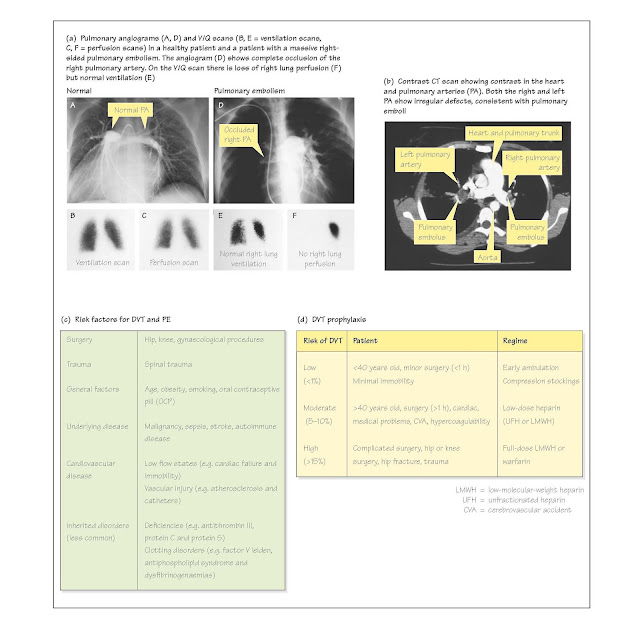 Venous Thromboembolism And Pulmonary Embolism