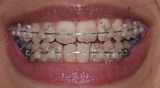 damon braces, damon clear braces, progress picture, photo, clear brackets, wires