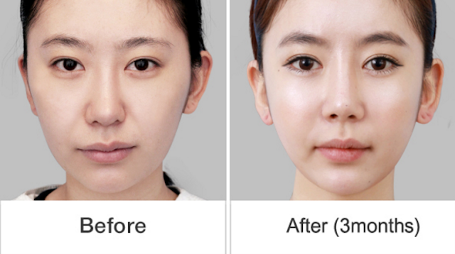 짱이뻐! - Wonjin Plastic Surgery Korea, Wow! Fantastic S-Line!