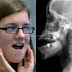 Student Dislocates Jaw While Yawning So Hard During Lecture