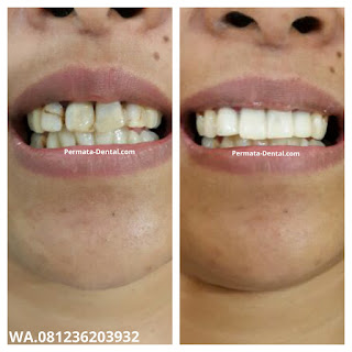 foto, gambar, gigi depan keropos Permata Dental Bali| sebelum dan sesudah gigi keropos diperbaiki di Permata Dental Bali | foto gigi keropos hitam Permata Dental Bali |gigi keropos karena sakit | gigi keropos berlubang | gigi keropos depan| gigi keropos bagian belakang | foto gigi keropos yang sudah diperbaiki Permata Dental Bali |  gigi keropos bagian depan| foto gigi keropos dan patah, foto gigi keropos oleh Permata Dental Bali, Bali Hits, Bali banget, area Bali, Bali kota, area kampus bali. veneer gigi keropos  Bali | veneer gigi keropos badung | veneer gigi keropos nusadua | veneer gigi keropos ngurahrai| veneer gigi keropos denpasar | veneer gigi kropos denpasar kota | veneer gigi keropos Bali | veneer gigi keropos gatsu | |veneer gigi keropos|  depan | veneer gigi keropos  atas | veneer gigi keropos  bawah | veneer gigi keropos  belakang |veneer gigi berlubang bali| veneer gigi berlubang Bali | veneer gigi berlubang nusadua| veneer gigi berlubang ngurahrai| veneer gigi berlubang Badung | veneer gigi berlubang depasar kota | veneer gigi berlubang denpasar| veneer gigi berlubang gatsu| veneer gigi berlubang jimbaran| veneer gigi berlubang bagus Permata Dental Bali | veneer gigi berlubang baik di Permata Dental Bali | veneer gigi berlubang cepat di Permata Dental Bali | veneer gigi berlubang murah di Permata Dental Bali | veneer gigi berlubang aman | veneer gigi berlubang mudah di Permata Dental Bali | veneer gigi berlubang promo Permata Dental Bali | gambar veneer gigi berlubang Permata Dental Bali | gambar sebelum dan sesudah veneer gigi hitam dan berlubang  veneer gigi hitam Bali | veneer gigi hitam Bali | veneer gigi hitam denpasar | veneer gigi hitam jimbaran | veneer gigi hitam nusadua | veneer gigi hitam Bali kota | veneer gigi hitam ngurahrai| veneer gigi hitam badung | veneer gigi hitam gatsu | veneer gigi hitam bagus | veneer gigi hitam baik | veneer gigi hitam cepat di Permata Dental Bali | veneer gigi hitam murah di Permata Dental Bali | veneer gigi hitam aman | veneer gigi hitam mudah di Permata Dental Bali | veneer gigi hitam promo Permata Dental Bali | gambar veneer gigi hitam Permata Dental Bali | gambar sebelum dan sesudah veneer gigi hitam dan berlubang Permata Dental