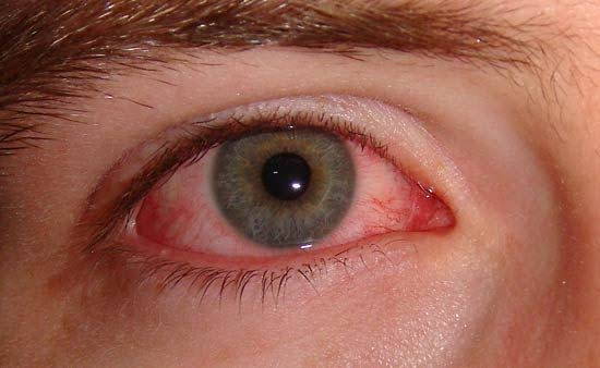 Causative organisms for different types of conjunctivitis