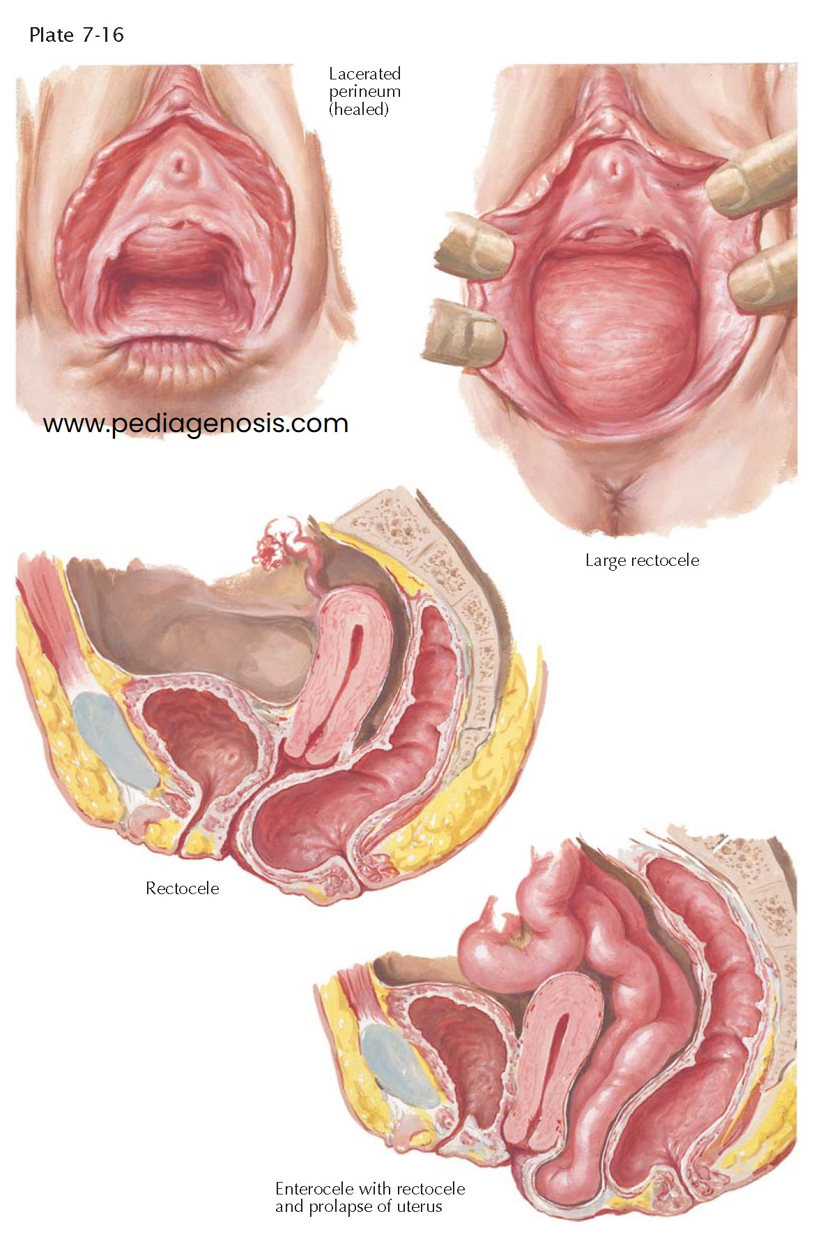 RECTOCELE, ENTEROCELE