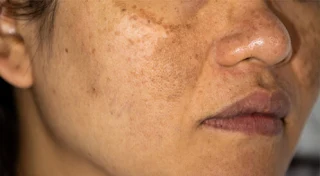 How do I get rid of freckles and acne?